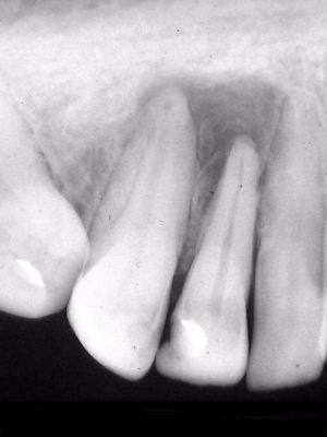 Granuloma-periapical.jpg