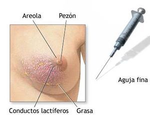 Foto de Biopsia de mama.JPG