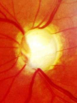 Glaucoma trastorno ocular .jpg