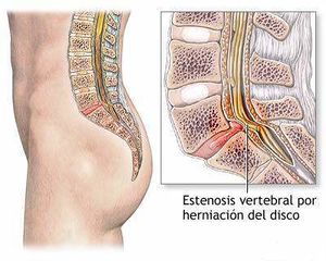 Estenosis raquidea.jpg