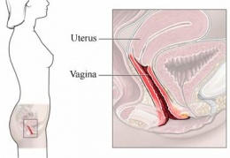 Vaginitis.JPG