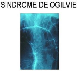 Síndrome de Ogilvie.jpg