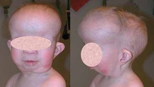 Sindrome de Potocki-Shaffer.jpeg