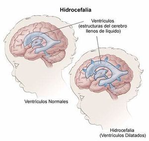 Hidrocefalia 2.jpg