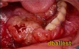 Ameloblastoma.jpeg