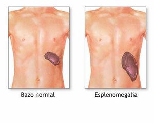 Esplenomegalia.jpg