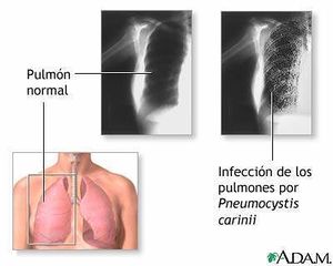 Neumocistosis.jpg