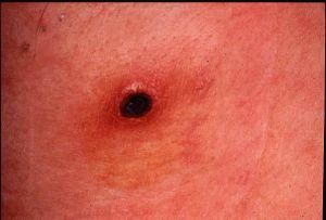 Rickettsiosis2.jpg