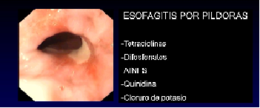 Esofagitis por píldora.png