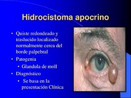 Hidrocistoma apocrino.jpg