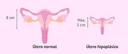 Hipoplasia uterina.jpg