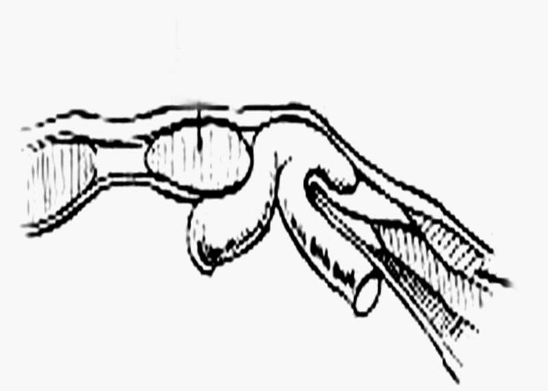 Archivo:Hernia Spiegel.jpg