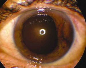 Melanoma uveal f10-01 (Small).jpg