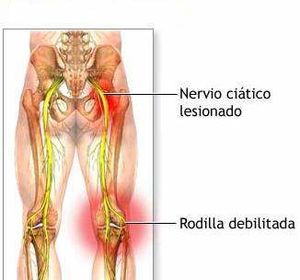 Polineuropatía inflamat. crónica.jpg