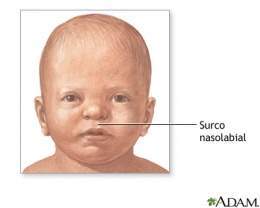Síndrome oral-facial-digital 9012.jpg