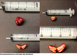 Somatostatinoma.png