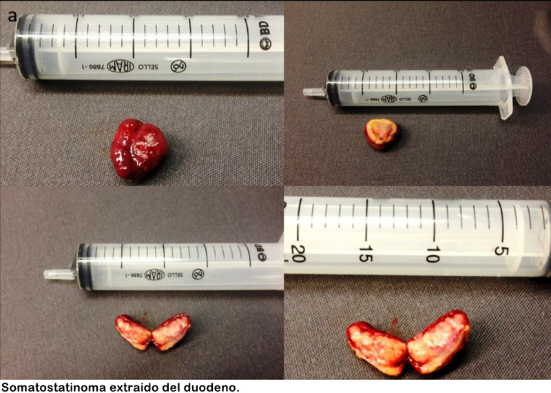 Archivo:Somatostatinoma.png