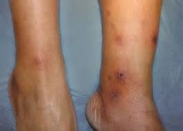 Panarteritis nudosa cutánea.jpg