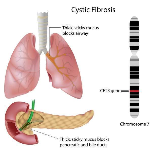 Archivo:FibrosisQ.jpg