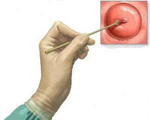 Cultivo endocervical.jpg