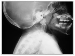 Sindrome-de-klippel-feil-5-638.jpg