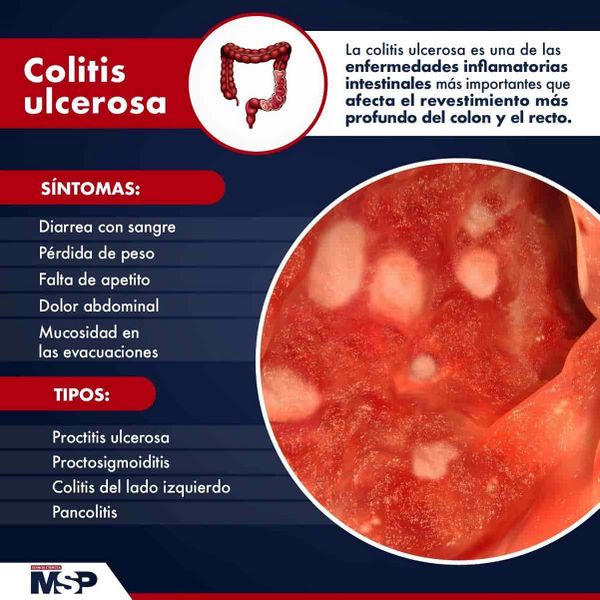 Archivo:Colitisulcerosa20dejulio 2.jpeg