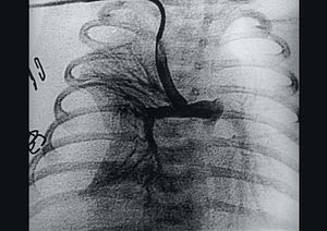Fístula arteriosa pulm 7802fig03.jpg