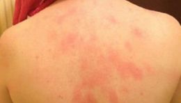 Alergia al agua.jpg