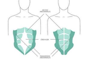 Diastasis 2.jpg