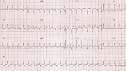 Taquicardia supraventricular.png