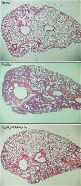Archivo:Fibrosis pulmonar1.jpg