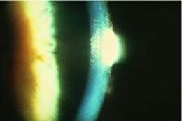 Distrofia corneal.jpg