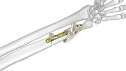 Osteotomia.jpg