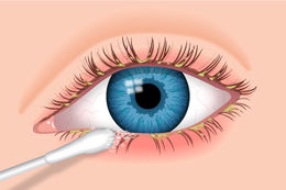 Blefaritis y sequedad en ojos.jpg