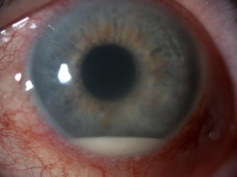 Uveítis anterior.JPG