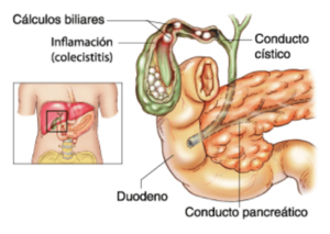 Colelitiasis.png