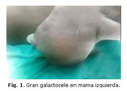 Galactocele.jpg