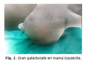 Galactocele.jpg
