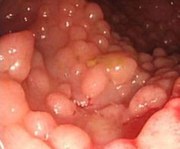 Poliposis adenomatosa familiar.jpg