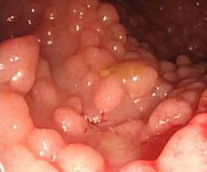 Poliposis adenomatosa familiar.jpg