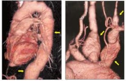 Arteritis de Takayasu2.jpeg