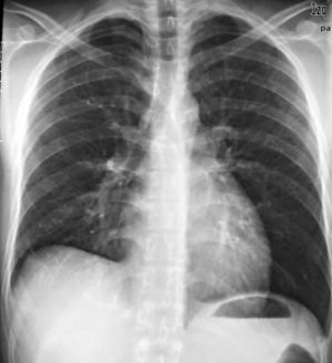 Pleuresía tuberculosa.jpg