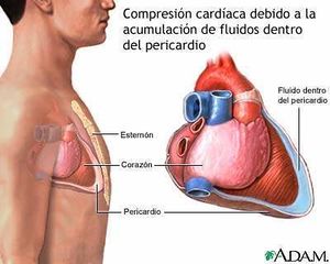 Taponamiento cardíaco-2.jpg