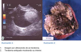 Teratoma extirpado 84.jpg