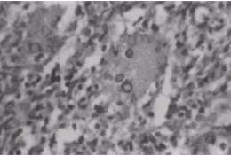 Cromoblastomicosisf0104101.jpg