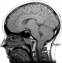 Síndrome-de-Arnold-Chiari-293x300.jpg