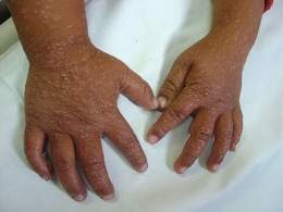 Dermatitis exfoliativa.jpg