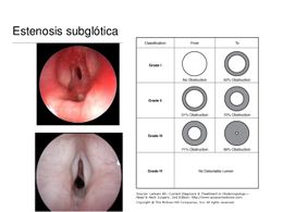 Estenosis subglótica24.jpg