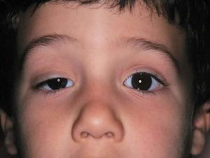 Ptosis.jpg