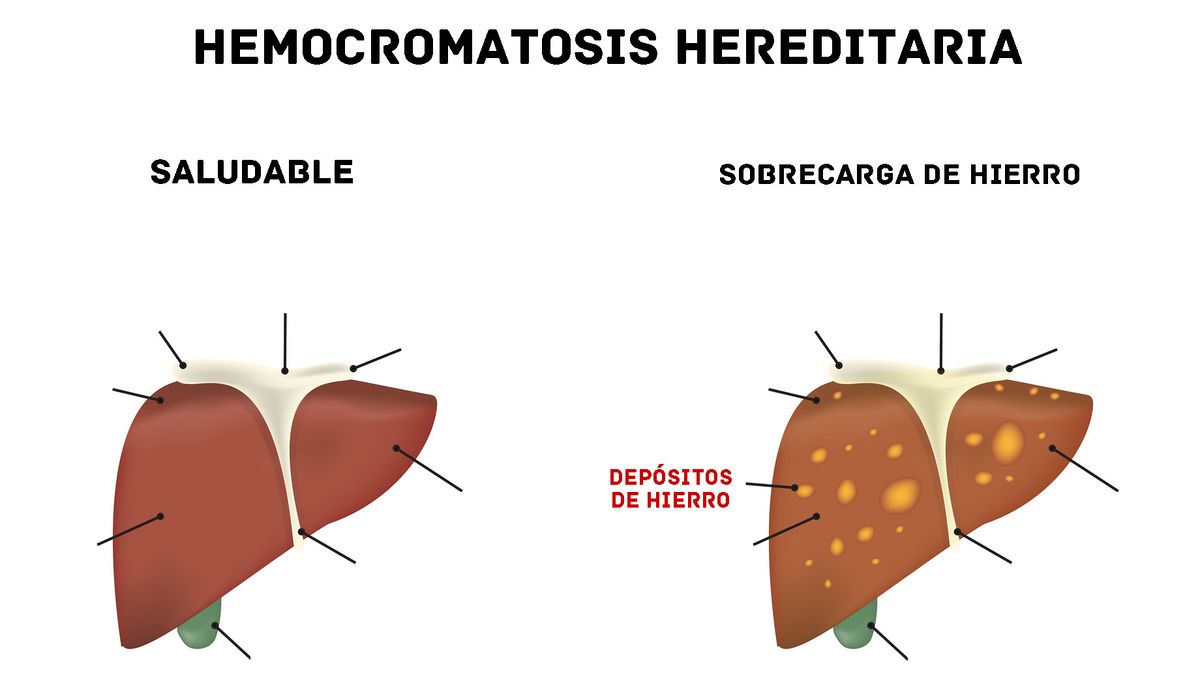 Hemocromatosis Hereditaria - EcuRed
